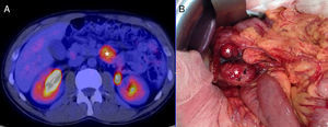 A) Imagen de PET/TC en la que se identifica la lesión a nivel duodenal, marcado con (*). B) Imagen intraoperatoria donde se observan dos lesiones tumorales en tercera y cuarta porción duodenal, marcados con (*).