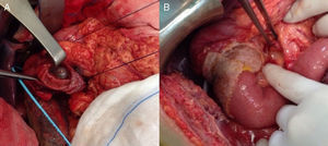 A) Resultado tras realización de la duodenectomía parcial. B) Reconstrucción del tránsito intestinal mediante anastomosis duodeno-yeyunal término-terminal y colocación de placa de Tachosil®.