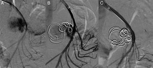 Arteriografía selectiva: A) Permeabilidad del PSAMS; B) Embolización con coils del saco, y C) Colocación del stent.