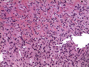 Biopsia de tumoración duodenal que corresponde a metástasis de carcinoma renal de células claras mostrando el patrón sarcomatoide del primario, caracterizado por agrupamiento de células fusiformes con patrón entrelazado y estoriforme, y pleomorfismo nuclear.