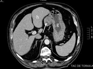 TC abdominal. Corte axial a la altura de la porción superior del abdomen en el que se observa una lesión sólida de unos 4cm (flecha) situada entre el hígado (h) y el estómago (g).