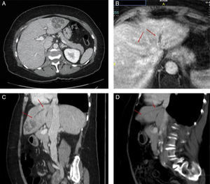 A) TC abdominal con diagnóstico de absceso hepático en segmento II/III 5,3×4,8×4,4cm. B) RM abdominal en la que se aprecia tromboflebitis de la vena hepática izquierda. Mediante ambas flechas se marca la diferencia de repleción de la vena hepática izquierda (tromboflebitis) con la media (normal). C y D) Comparativa de la TC abdominal de diagnóstico (C) y la TC abdominal a los 2 meses de la colocación del drenaje percutáneo (D). Las flechas señalan el trayecto de tromboflebitis de la vena hepática izquierda en corte sagital. Se identifica una marcada reducción del absceso, pero la persistencia de la tromboflebitis de la vena hepática izquierda (flechas). En el control ecográfico a los 7 meses, se confirma una completa resolución.