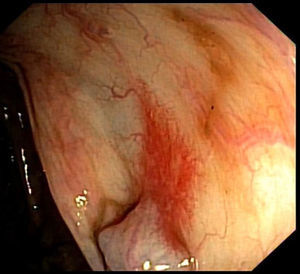 Colonoscopy showing typical findings of portal hypertensive colopathy: erythema and angiectasia.
