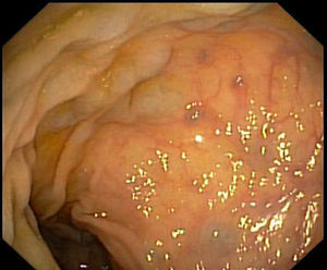 Colonoscopy showing typical findings of portal hypertensive colopathy: edema and varices.