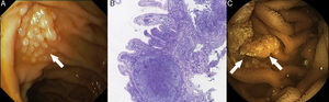 A) Lesión sobreelevada blanquecina y nodular yuxta-papilar, con (B) proliferación de células B formada por centrocitos y centroblastos (H&E ×40). (C) LF-PI duodenal mediante enteroscopia con cápsula.