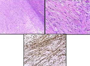 Descripción de izquierda a derecha y de superior a inferior: leiomioma en relación con el parénquima hepático (borde superior derecho). Células del leiomioma. Expresión inmunohistoquímica de actina de las células de la proliferación (inmunohistoquímica con anticuerpo monoclonal anti-actina ×20).