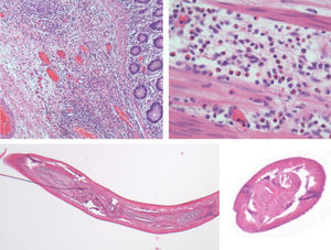 Colitis eosinofílica con importante edema e infiltrado inflamatorio, con presencia de eosinófilos. Corte longitudinal y transversal del parásito.
