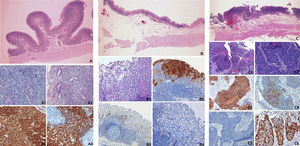 Immunostaing of triple synchronous gastric tumors. A. Panoramic view-slide with enlargement of the mucosal folds. Lymphoid follicles are observed. Mucosa and submucosa involvement. A1: Diffuse infiltrate of intermediate size lymphocytes with a small nucleoli and scanty cytoplasm. A2: Lymphoepithelial lesion. A3: Immunohistochemistry for CD20. A4: Immunohistochemistry for Bcl-2. B: Panoramic view-slide with adenocarcinoma. B1: Proliferation of epithelial cells with a diffuse growth and signet ring cells. B2: Immunohistochemistry for CEA. B3: Immunohistochemistry for CD56, absence of expression in tumor cells. B4: Immunohistochemistry synaptophysin, absence of expression.