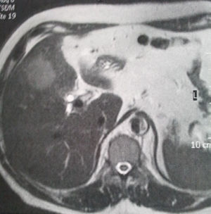 Resonancia magnética. Imagen sugestiva de neoplasia de vesícula biliar.