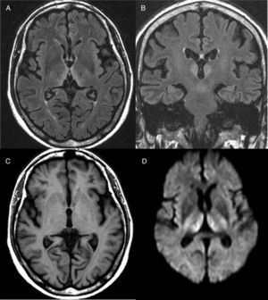 Resonancia magnética cerebral de un paciente con encefalopatía de Wernicke. Sobre corte axial (A) y coronal (B) potenciado en fluid attenuation inversion recovery (FLAIR), se aprecia hiperintensidad bitalámica medial rodeando el tercer ventrículo. C) Corte axial potenciado en T1 en el que no se observan lesiones. D) Corte axial en difusión (DWI) en el que se aprecia una hiperseñal de la difusión en ambos tálamos simétrica.