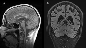 RM cerebral de un paciente con degeneración cerebelosa alcohólica. Corte sagital T1 (A) y coronal (B) en FLAIR muestran atrofia cerebelosa de predominio vermiano.