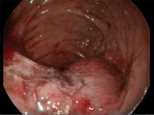 Úlcera sobre válvula ileocecal.