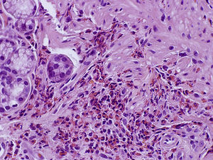 Duodenal biopsy histopathology showing focal fold shortening with eosinophilic infiltration in lamina propria.