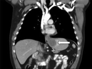 Tomografía axial computarizada: tumoración sólida de localización subepitelial del tercio distal del esófago, que atraviesa cardias, llegando al cuerpo gástrico.