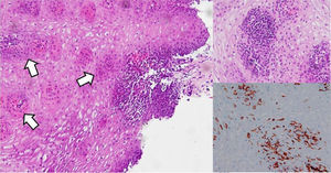 Left panel. Esophageal biopsy revealing heavy lymphocytic infiltration with papillar and peripapillar localization (white arrows) and intercellular edema (spongiosis), in the absence of either neutrophils or eosinophils. Right panel. A more detailed picture of lymphocytic infiltration, showing >25 CD4+ intraepithelial lymphocytes per 100 epithelial cells.