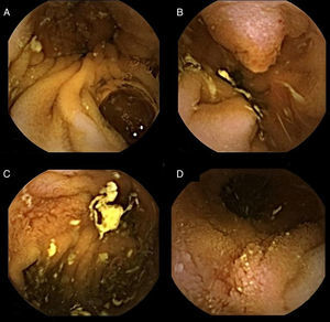 Capsule endoscopy findings. From left to right, CE showing a double lumen, due to the anastomosis of the trasplanted duodenum to the recipient jejunum (A), a polypoid ampulla of Vater (B) and an atrophic mucosa area with ulcerative longitudinal and geographic lesions (C, D).