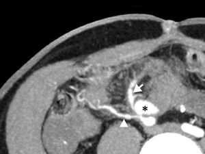 CT image showing the pseudoaneurysm (*) originating from the anastomosis of the superior mesenteric artery of the pancreatic transplant (white arrow) with the Y graft of the donor. The patency of the splenic artery of the allograft (white arrowhead) can be seen.