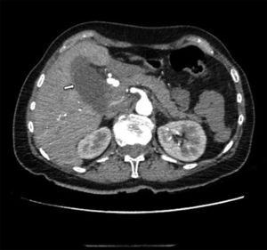 Abdominal CT scan showing a collection at the gallbladder bed (arrow).