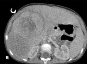 Imagen de la tomografía del abdomen al diagnóstico.