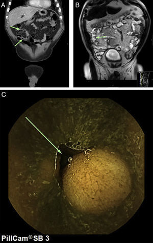 A) Corte coronal de la TC toracoabdominal con tumoraciones a nivel de íleon. B) Corte coronal de la RM intestinal en secuencia T2 con tumoraciones a nivel de íleon. C) Tumoración de íleon visualizada con cápsula endoscópica.