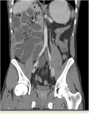 Coronal CT-scan showing abnormal location of the large bowel on the left side of the abdomen and a right-sided small intestine, without signs of bowel strangulation.