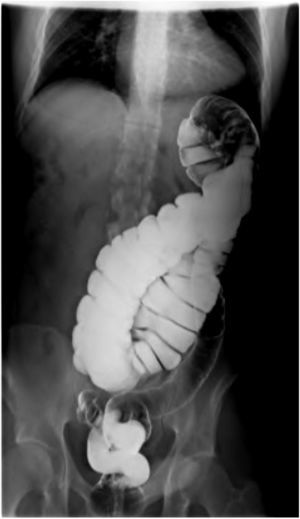 Barium enema showing the large bowel on the left side of the abdomen.