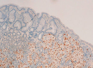 Inmunohistoquímica (GATA-3) que confirma el origen mamario.
