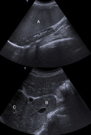 Ecografía hepática. En los cortes mostrados se aprecian los signos característicos de cirrosis hepática: A) Esplenomegalia de 184mm; B) Hipertrofia del lóbulo caudado, y C) Hipotrofia del lóbulo hepático derecho.