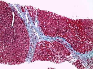 Corte de la biopsia hepática con tinción de tricrómico de Masson a ×100 mostrando puentes de fibrosis.