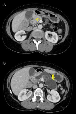 A y B) Tomografía computarizada: lesión quística de apariencia lobulada-tabicada mostrando continuidad con el conducto pancreático principal.