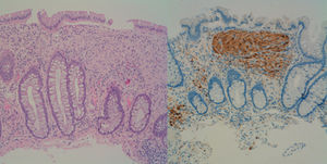 A la izquierda, microfotografía de un pólipo ganglioneuromatoso con tinción de hematoxilina-eosina. A la derecha, inmunohistoquímica para S100 que marca el componente neural.