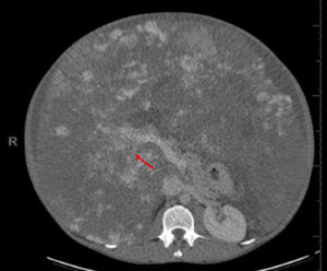 Compresión vascular a nivel de la bifurcación portal (flecha), visto en la TC abdominal con contraste.