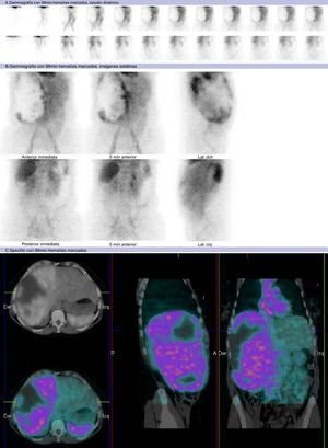 Gammagrafía con 99mTc-hematíes autólogos marcados (A: estudio dinámico; B: imágenes estáticas; C: imágenes tardías; D: imágenes de fusión SPECT/TC), mostrando aumento marcado del metabolismo en LHD (C) con relación a hemangioma, respecto al resto del hígado que muestra captación homogénea. Dentro del hemangioma se observan áreas de ausencia total de captación en probable relación con infartos o zonas necróticas intralesionales.