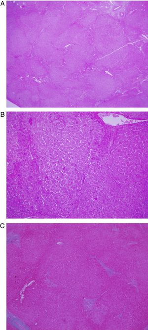 A) Baja magnificación (×2) con tinción con hematoxilina-eosina, evidencia áreas de hiperplasia nodular regenerativa y septos fibrosos delicados que a menudo son incompletos. B) Mayor magnificación (×10). C) Tinción tricrómica de Masson mostrando fibrosis periportal sin conexiones visible con otros tractos portales.