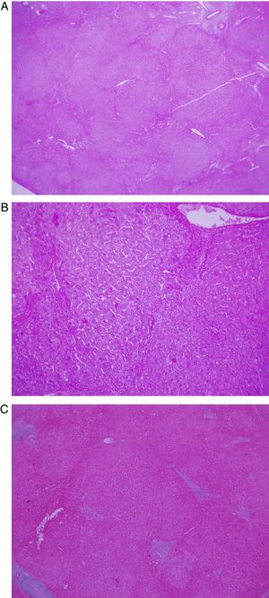 A) Baja magnificación (×2) con tinción con hematoxilina-eosina, evidencia áreas de hiperplasia nodular regenerativa y septos fibrosos delicados que a menudo son incompletos. B) Mayor magnificación (×10). C) Tinción tricrómica de Masson mostrando fibrosis periportal sin conexiones visible con otros tractos portales.