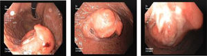 Upper gastrointestinal endoscopy showing a 40mm polypoid lesion in the gastric body with normal mucosa surface and a central 15mm ulcerated bleeding suggestive of a gastrointestinal stromal tumor.