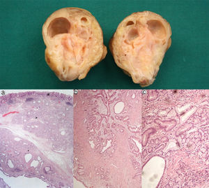 Cross-section shows multiple cysts with diameters between 0.2 and 1.5cm, filled with transparent and mucinous-looking liquid. (a) (H&E ×20): gastric wall including mucosa (#), submucosa (>) and muscularis propria (*) with abundant cystic glandular proliferation; (b) (H&E ×40): surrounding the glands there is a thin layer of lamina propria and fibromuscular hyperplasia; (c) (H&E ×100): the glands are lined by pyloric-type and foveolar-type epithelium, without mitoses or atypia.