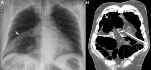 A) Radiografía de tórax. Segmento de colon distendido en hemitórax derecho (flecha). B) TC de abdomen. Hernia de Morgagni incarcerada de colon transverso que condiciona cuadro de oclusión intestinal (flecha).