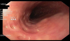 A y B) Esófago con áreas estrechas con divertículos y puentes mucosos.