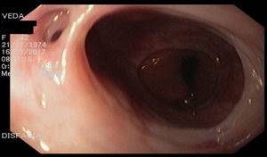 A y B) Esófago con áreas estrechas con divertículos y puentes mucosos.