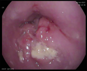 Vertiente distal de neoformación esofágica cervical estenosante, vista por endoscopia retrógrada (a través de gastrostomía).