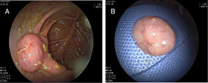 (A) Colonoscopic view of the lesion before the resection. Polypoid mass located on the Ileocecal valve. (B) 20-mm subpediculated polyp extracted.