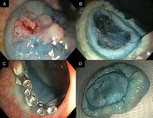 (A) Endoscopic image of the 20mm non-granular laterally spreading colonic tumor. (B) The mirror target sign identified immediately after EMR of the lesion. (C) Endoscopic closure of the MP defect with 5 clips. (D) Target sign on the resected specimen.