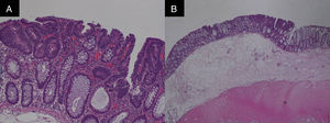 (A) High-grade dysplasia tubular adenoma without submucosal invasion. ×100. Hematoxylin-eosin staining. (B) Specimen showing partial resection of the muscularis propria (*). ×20. Hematoxylin-eosin staining.