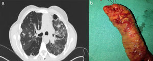 1a. Tomografía axial computarizada torácica. Signos de fibrotórax con patrón parcheado en panal de abeja, y aumento de la densidad por posible neumonía intersticial izquierda. Pequeñas bronquiectasias cilíndricas y patrón bulloso con algunas ampollas subpleurales. 1b. Pieza quirúrgica. Segmento de resección ileal con evidencia macroscópica de úlceras en la pieza quirúrgica.