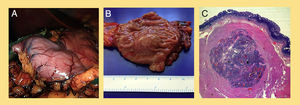 A)Imagen de la cirugía en la que se está realizando sección distal a la tumoración con endograpadora. B)Pieza quirúrgica en fresco, con lesión subepitelial antral. C)Imagen microscópica: tumoración dependiente de la submucosa, nodular y bien delimitada, con proliferación de células dispuestas alrededor de vasos dilatados.