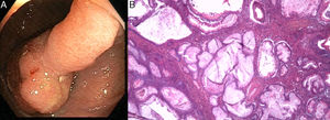 A) Pólipo pediculado (0-Ip) de gran tamaño identificado durante estudio endoscópico. B) Pólipo mioglandular inflamatorio compuesto por lóbulos de criptas hiperplásicas y dilatadas, separadas por bandas de tejido fibromuscular, con tejido de granulación (H&E ×200).