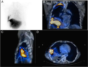 A) Gammagrafía hepatobiliar. Imagen planar. B-D) SPECT/TC coronal, sagital y axial. Se observa el paso del radiofármaco a través de la fístula al espacio pleuro-pulmonar derecho.