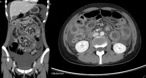 Contrast-enhanced abdominal-pelvic computed tomography scan showing voluminous ascites, diffuse and circumferential oedematous thickening of the small bowel wall with luminal dilation and parietal enhancement as “target sign”, compatible with lupus enteritis (axial and coronal views).