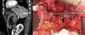 Imagen lateral de la TC abdominal en la que se observa la colección retroperitoneal que fistuliza al espacio pleural (flecha blanca) e imagen de la intervención quirúrgica (con orificio fistuloso, flecha negra).